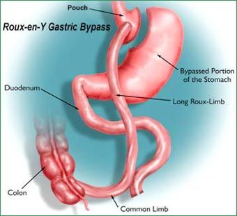 Gastric Bypass