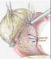 Dissection of Gallbladder from Liver Bed