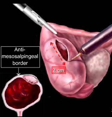 ... Management of Ectopic Pregnancy - World Laparoscopy Hospital