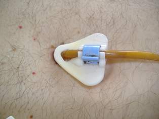 PEG