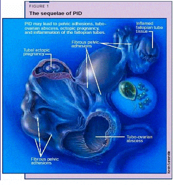 ectopic pregnancy,