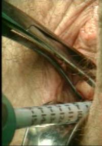 faq laparoscopic hysterectomy clip