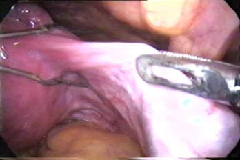 faq laparoscopic hysterectomy clip