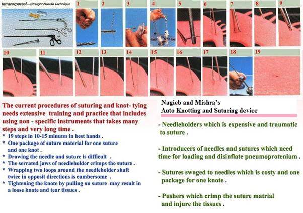 Minimally invasive knot-tying. (A) The knot-typing procedure starts