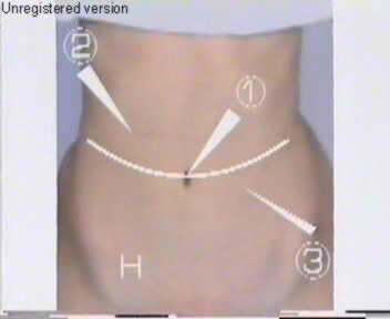 Lap Hernia