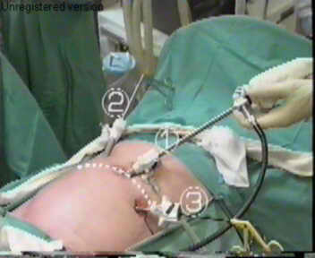 Lap Hernia