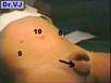 Laparoscopic Nissen Fundoplication Versus Open Surgery clip