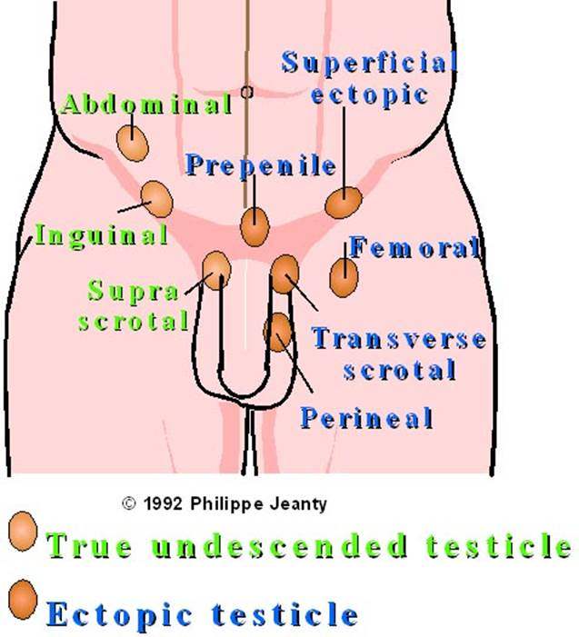 Ectopie testiculaire (et Cryptorchidie ) - Pediatric Surgery