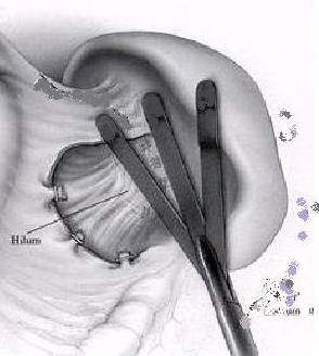 Laparoscopic versus open splenectomy clip