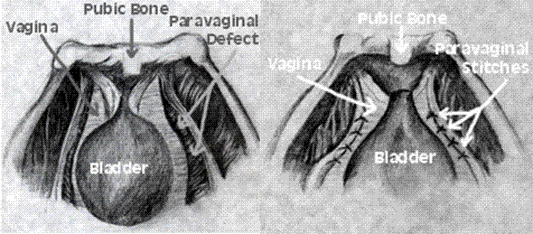 Minimal Access Surgery