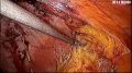 Laparoscopic repair of Two Port Ventral Hernia & incisional hernia Repair with IPOM technique. Demonstration By Dr.J.S. Chowhan.