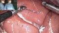 Laparoscopic Surgeons Knot