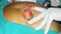 Live Demonstration to Surgeon of Laparoscopic Umbilical Hernia IPOM Repair Surgery Demonstration By Prof.Dr. R.K. Mishra