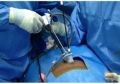 Single incision laparoscopic surgery (SILS) System provides surgeons and patients with the most advanced minimally Invasive Surgery, Hands on Training (SILS) for Surgeon & gynecologist Demonstration by Dr. J. S. Chowhan