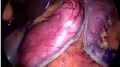 Bariatric surgery for Surgeon and Sacrohysteropexy for Gynecologists