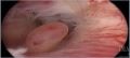 Gynecologists learnt Hysteroscopy today