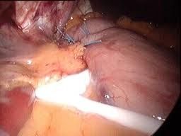 النتائج طويلة المدى لعملية ربط المعدة بالمنظار