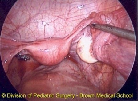 LaparoscopicOophorectomy