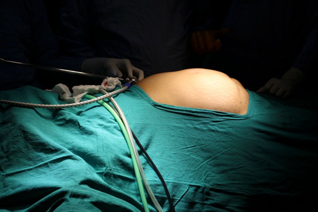 Laparoscopic Training