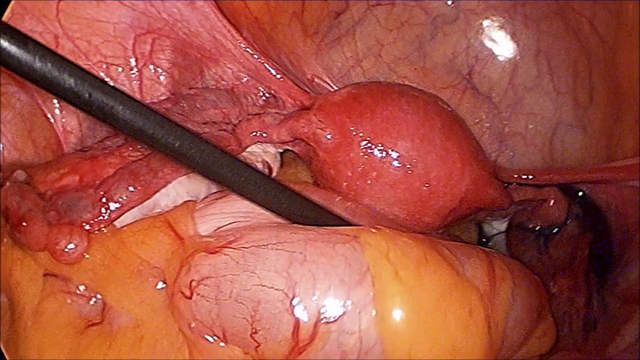 Laparoscopic Surgery Training