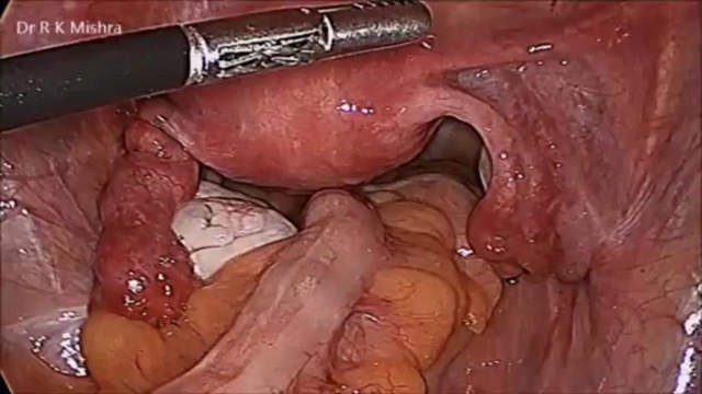 Laparoscopic Surgery Training