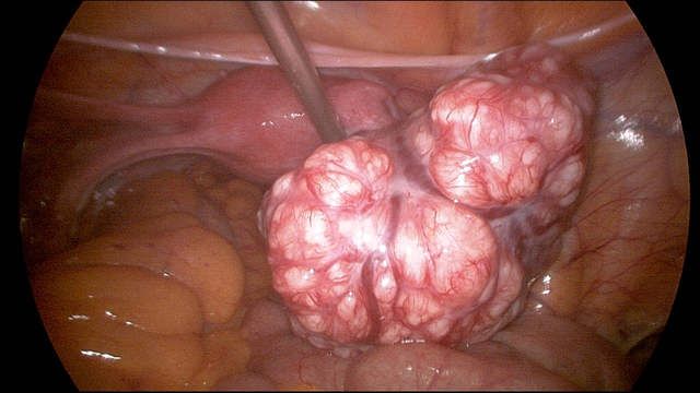 Laparoscopic Surgery Training