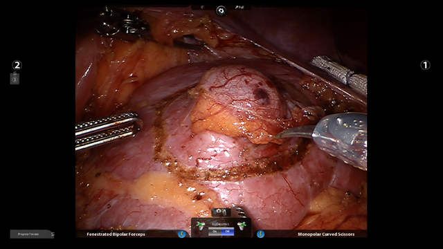 Laparoscopic Surgery Training
