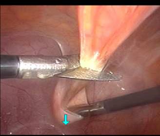 Laparoscopic Burch suspension