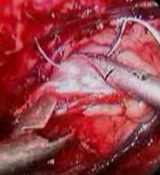 Suturing of paravaginal fascia