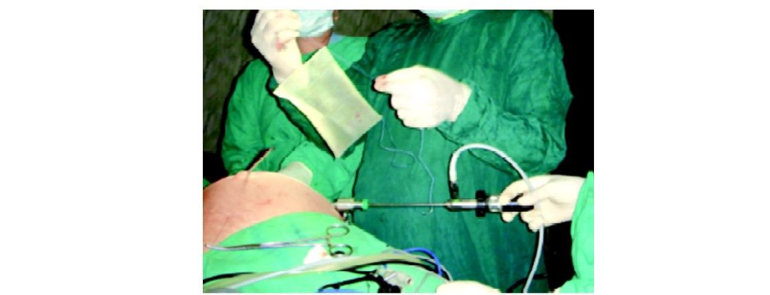 Twelve centimeter long Prolene is tied at three corner of the mesh keeping 6 cm long pair of free suture at each end
