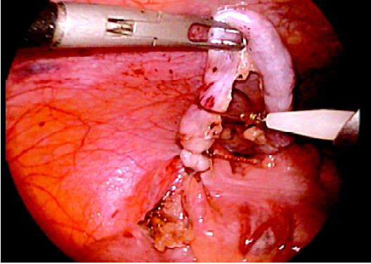 Three Roeder’s or Meltzer's knot over appendix