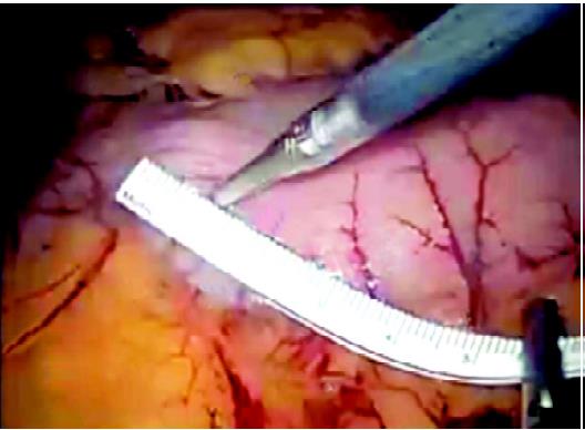 6 cm of stomach towards the pylorus is left