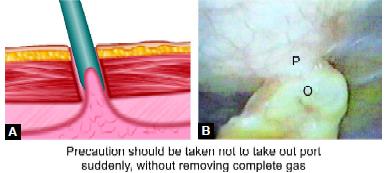Adhesion may form if cannula is pulled rapidly at the end of surgery P: Peritonium, O: Omentum
