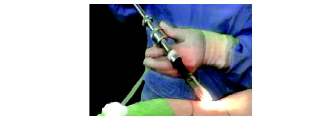 Laparoscope with balloon cannula system