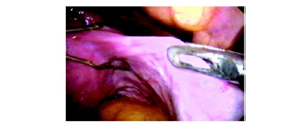 Laparoscopically assisted vaginal hysterectomy (LAVH) using bipolar