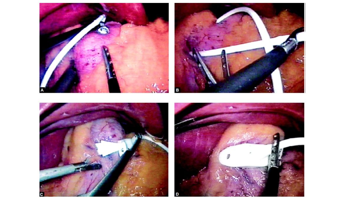Band is pulled from below the stomach through retrogastric tunnel and is tightened leaving 15 ml volume of stomach above