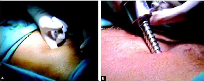 Access technique of totally extraperitoneal hernia repair
