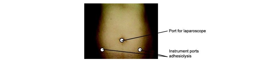 Three ports for pelvic adhesiolysis