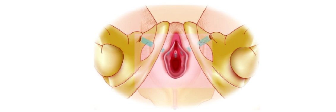 Adjust the tape, remove plastic sheath and close incision