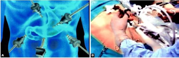 Alternative port position in laparoscopic fundoplication