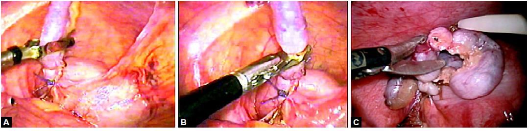 Amputation of an appendix