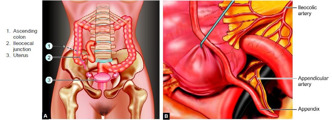 Anatomic position of the appendix