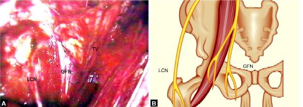 Anatomical landmarks, TV–Testicular vessel, GFN–Genitofemoral nerve, LCN–Lateral cutaneous nerve of high