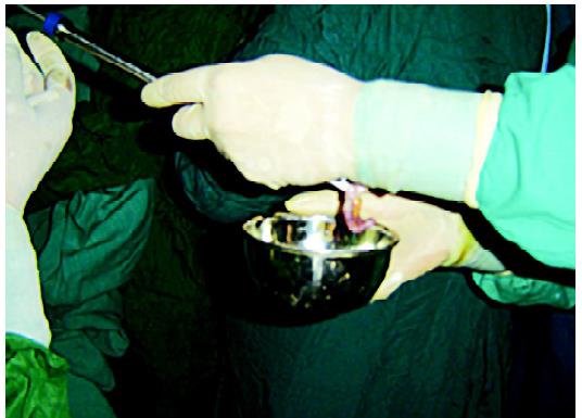 Appendix hidden in the cannula is ejected out