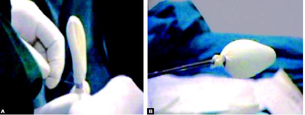 Making balloon dissection with finger of gloves