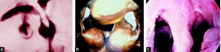 Bicornuate uterus