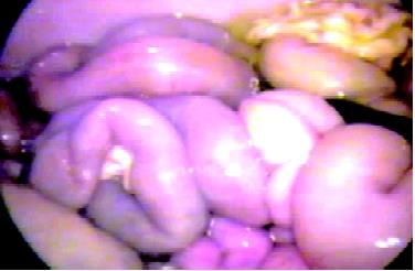 Perforation bowel during hernia surgery