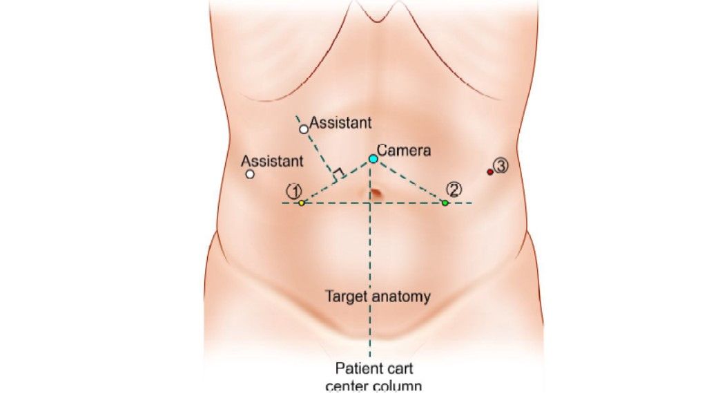 Camera port positioning