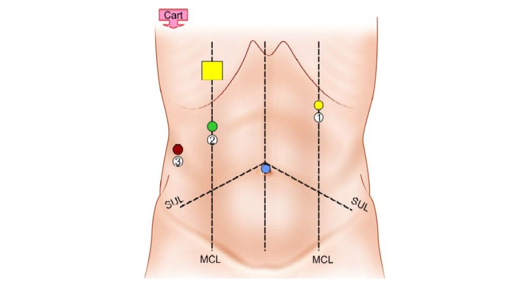 Robotic Cholecystectomy Procedure