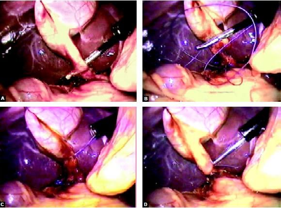 Clip or extracorporeal Meltzer knot is applied over cystic artery and duct